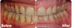 Whiter teeth with daily ProBiora use