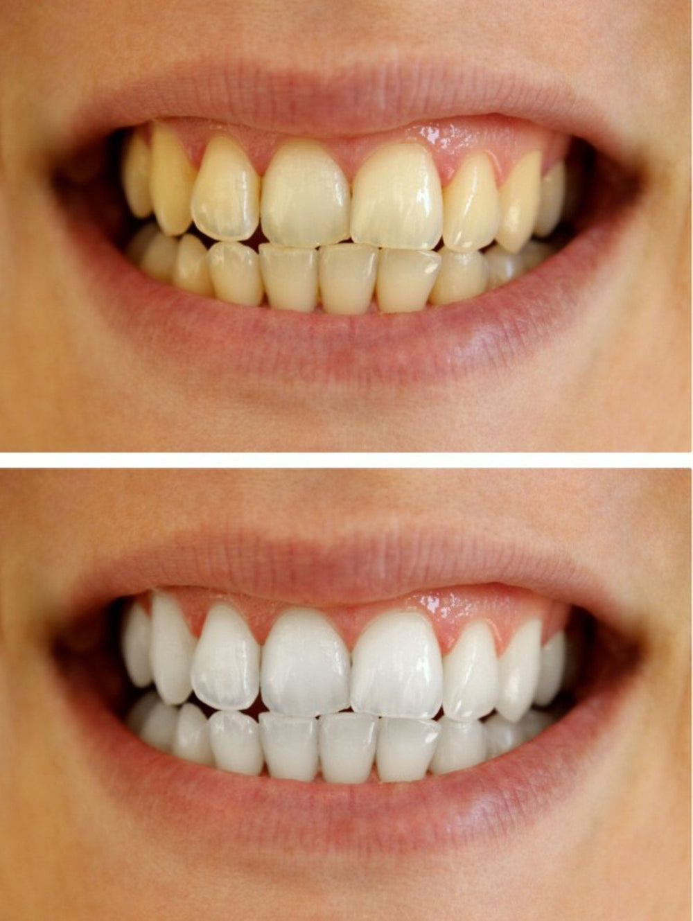 Professional-grade teeth whitening gel components