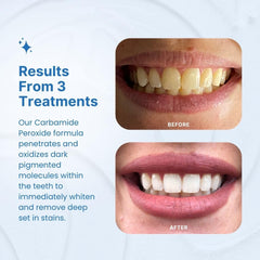 Moldable mouth trays for whitening in PurelyWHITE DELUXE kit