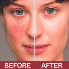 QUATRIDERM NF for eczema flare-ups during daily use.