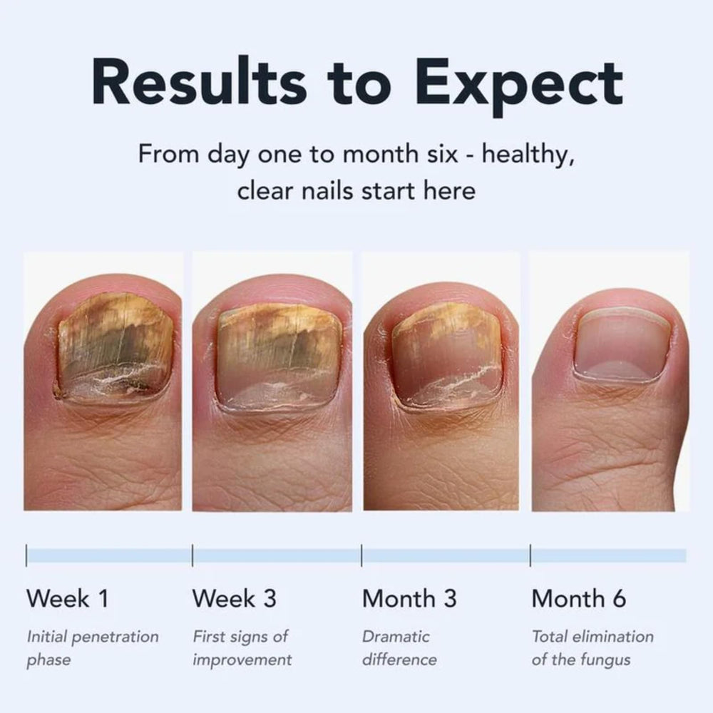SASSYTIP Fungal Nail Pen precision tip enables clean, direct nail coverage.