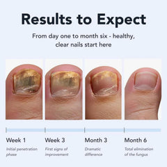 SASSYTIP Fungal Nail Pen precision tip enables clean, direct nail coverage.