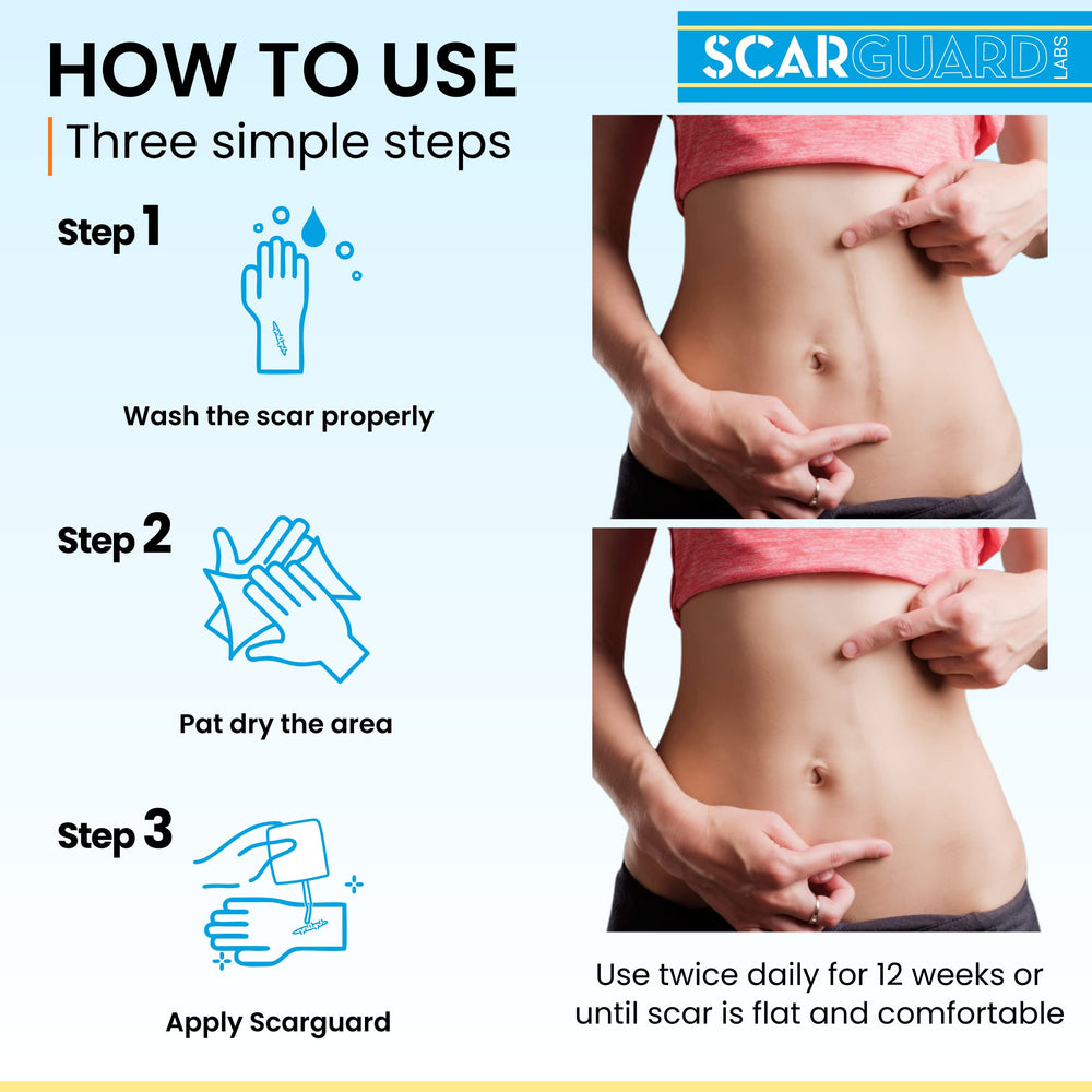 ScarGuard surgeon-preferred silicone treatment for post-surgery scars