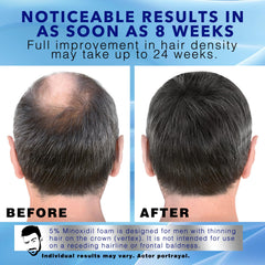 Sefralls Minoxidil Foam close-up of foam texture indicates gentle absorption on the scalp