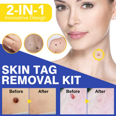 SHISUIZHE cryogen application tip showing precise skin tag removal