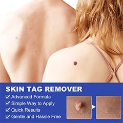 SHISUIZHE reliable at-home skin tag removal kit for adults