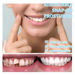 Close-up of smile set aligning with teeth