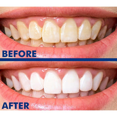 SmileWhite whitening results showing up to 8 shades brighter