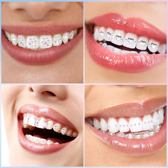 Teeth sparkling with crystal gems after applying