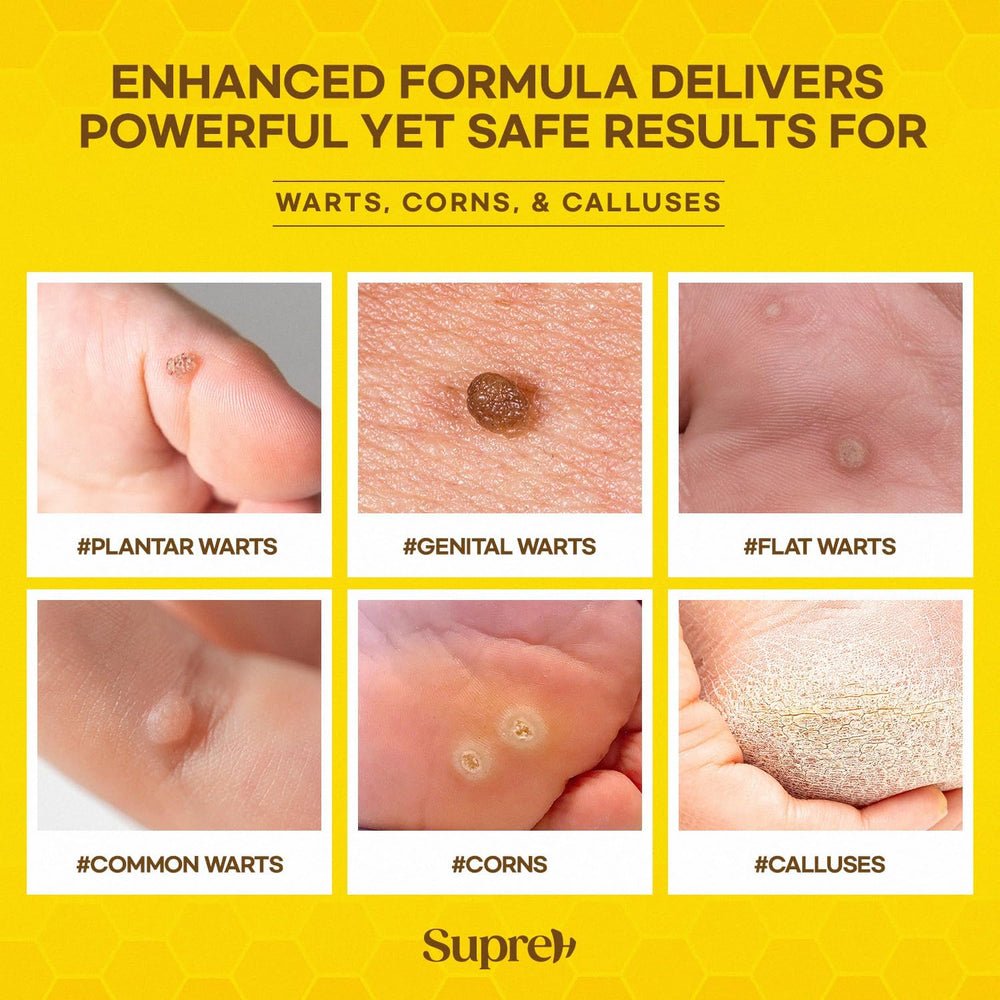 SupreH corn-relief use-case image highlights versatility.