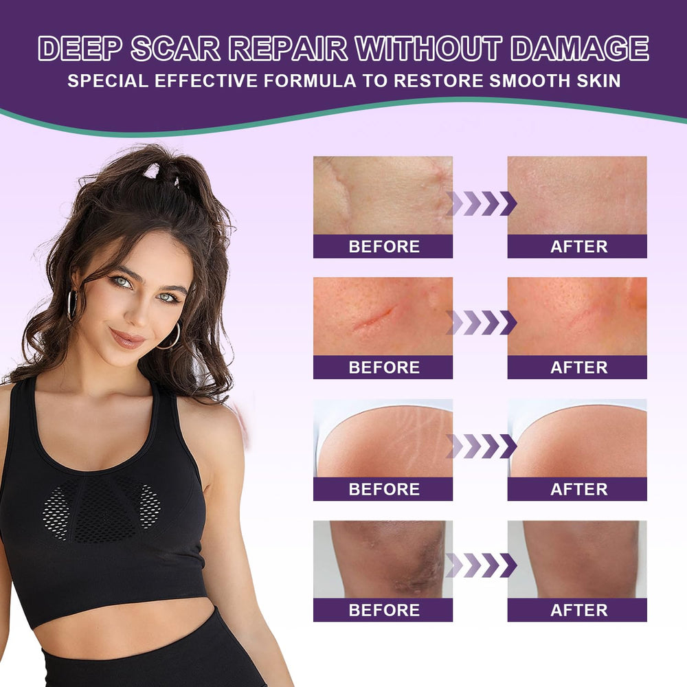 Travel-friendly Tearich silicone scar cream bottle for convenient touch-ups