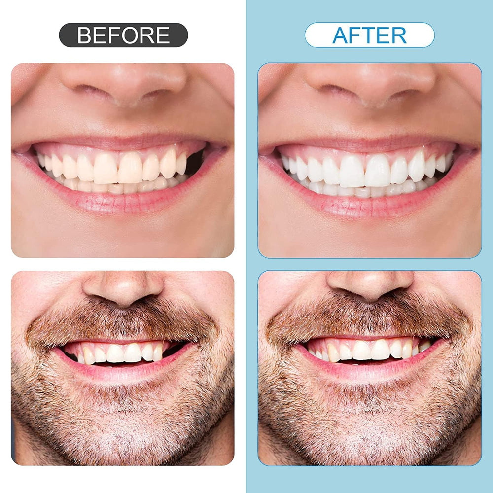 DIY temporary tooth restoration kit for at-home use