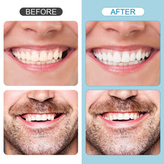 DIY temporary tooth restoration kit for at-home use