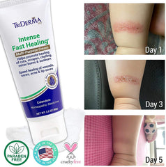 TriDerma MD Intense Fast Healing Cream on dry skin showing soothing relief potential