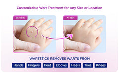 WartStick solid-stick application closeup highlights clean, mess-free wart treatment.