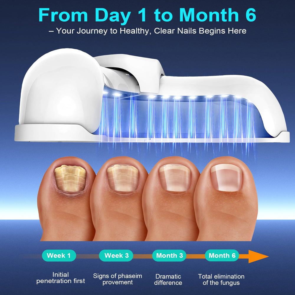 XiNanc Nail Fungus Laser Device LED panel guides controlled treatment.