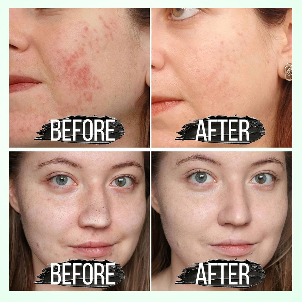 YFIXQNSU charcoal nose mask pore cleansing during routine.