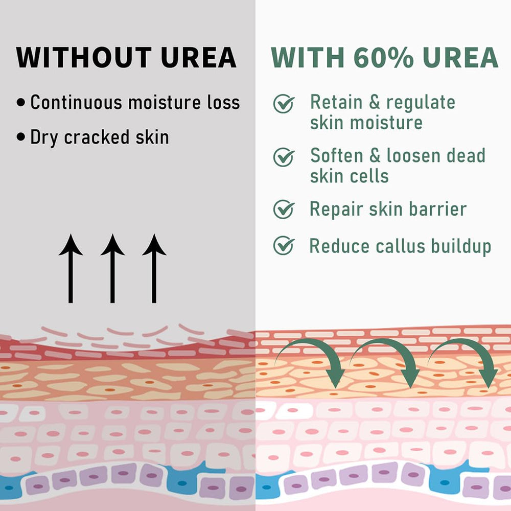 60% Urea Cream on elbows and knees for moisturized, smoother skin