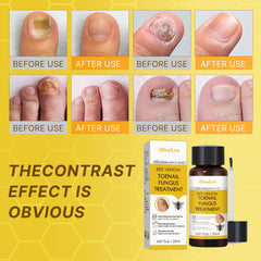 Aimery Bee Venom Antifungal Solution on yellowing nail illustrates common fungal signs and care.