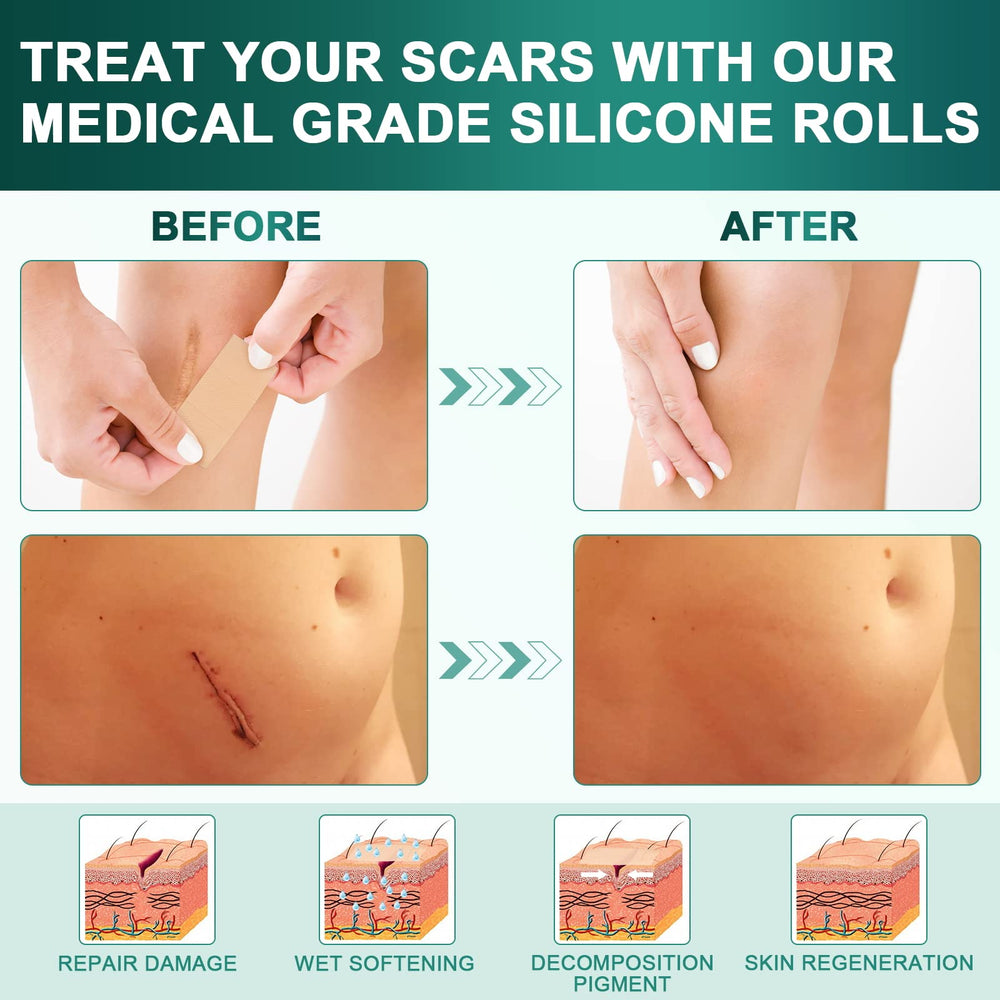 AirroYE silicone scar sheets on skin provide breathable discreet healing