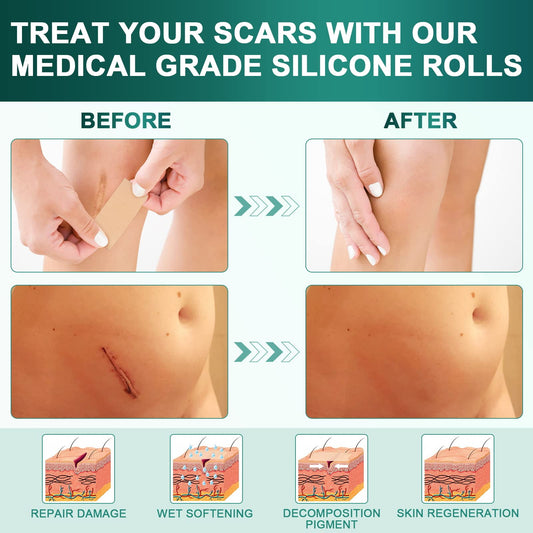 AirroYE silicone scar sheets on skin provide breathable discreet healing