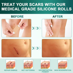 AirroYE silicone scar sheets on skin provide breathable discreet healing