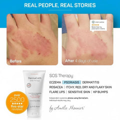 Applying DermaCalm SOS cream on hand for itch relief