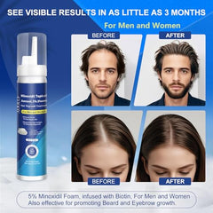 AOOLCF Minoxidil Foam on scalp during application for even coverage