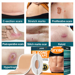 Arme silicone scar tape adheres well during wear on sensitive skin