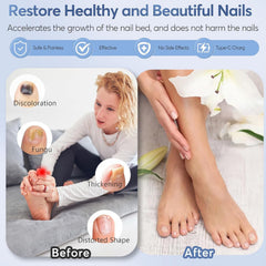 ASLAWU nail fungus laser device recharge port for convenient home use.