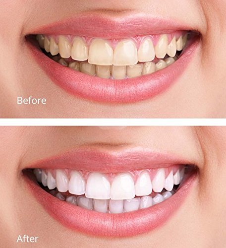 At-home whitening kit contents and packaging.
