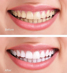 At-home whitening kit contents and packaging.