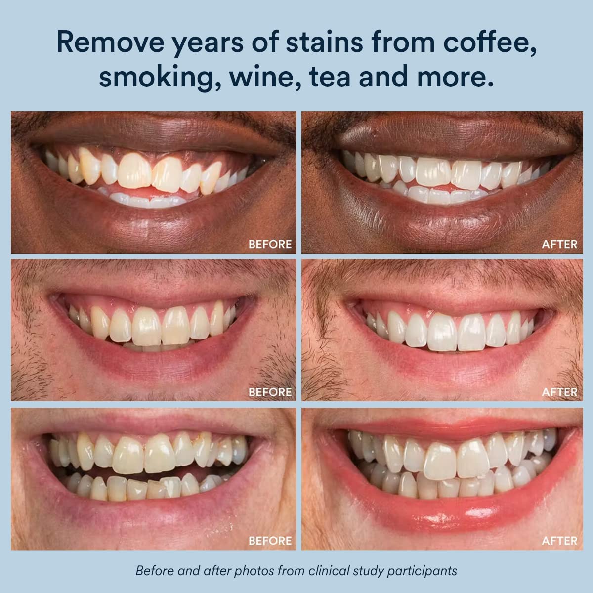 Chart illustrating whitening results after treatment