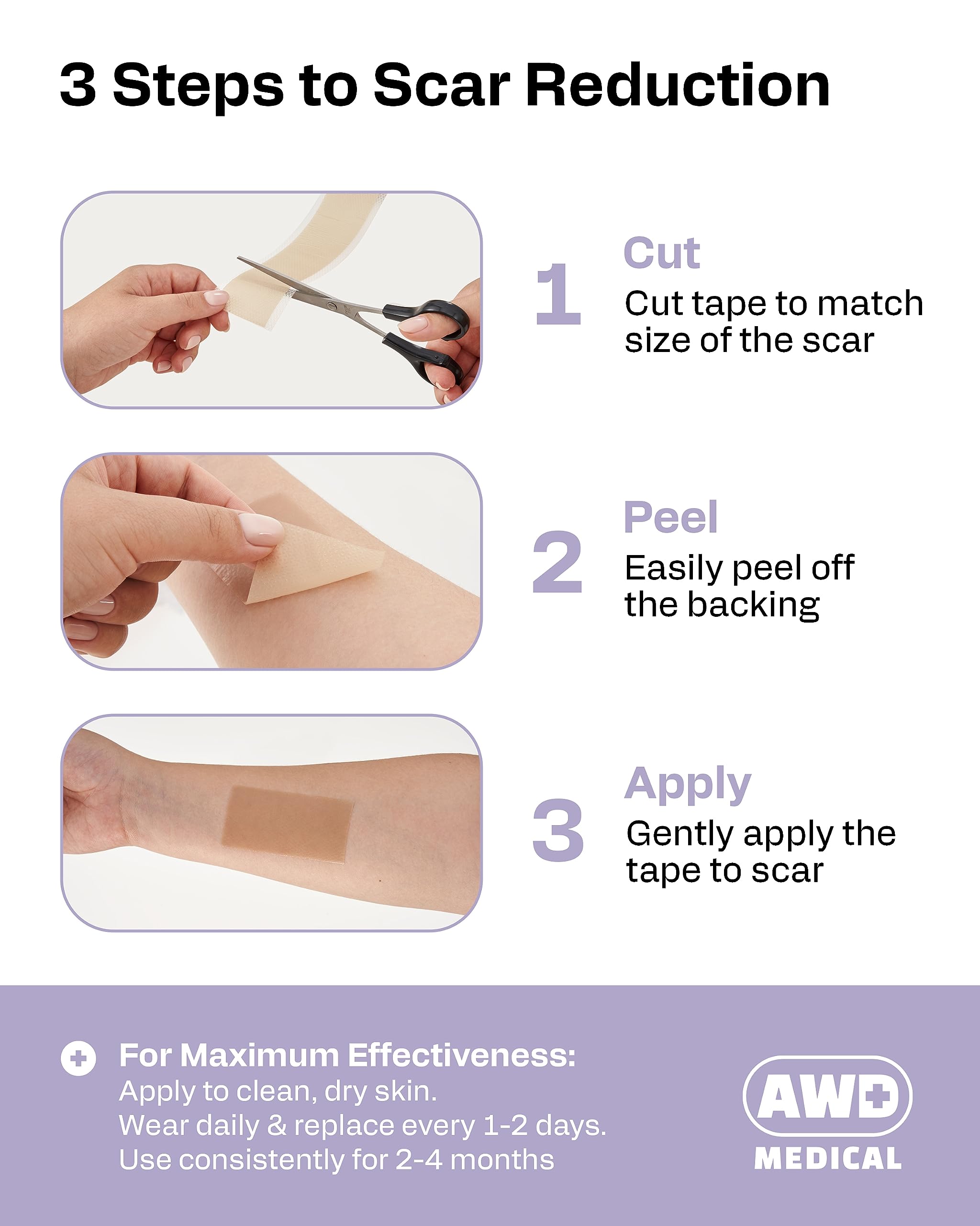 AWD scar tape applied to a surgical scar for discreet wear under clothing.