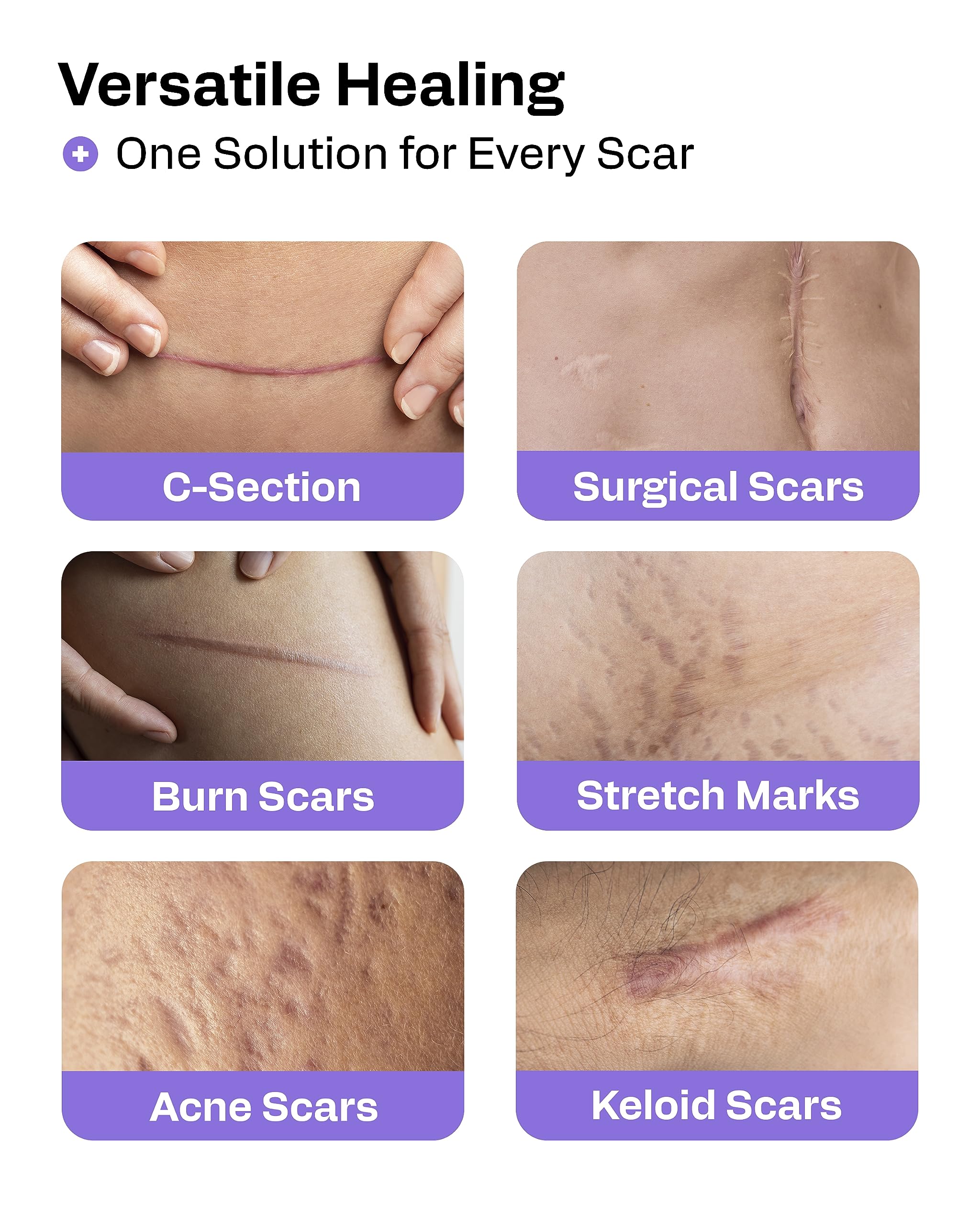 AWD Medical silicone scar tape over a C-section scar for gentle flattening