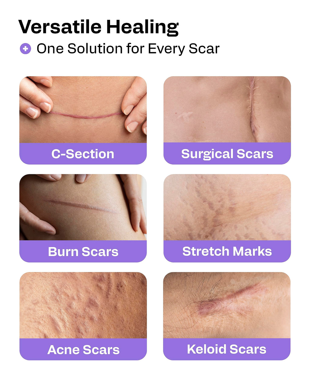 AWD Medical silicone scar tape over a C-section scar for gentle flattening