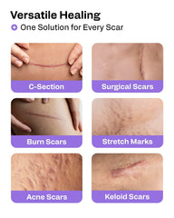AWD Medical silicone scar tape over a C-section scar for gentle flattening