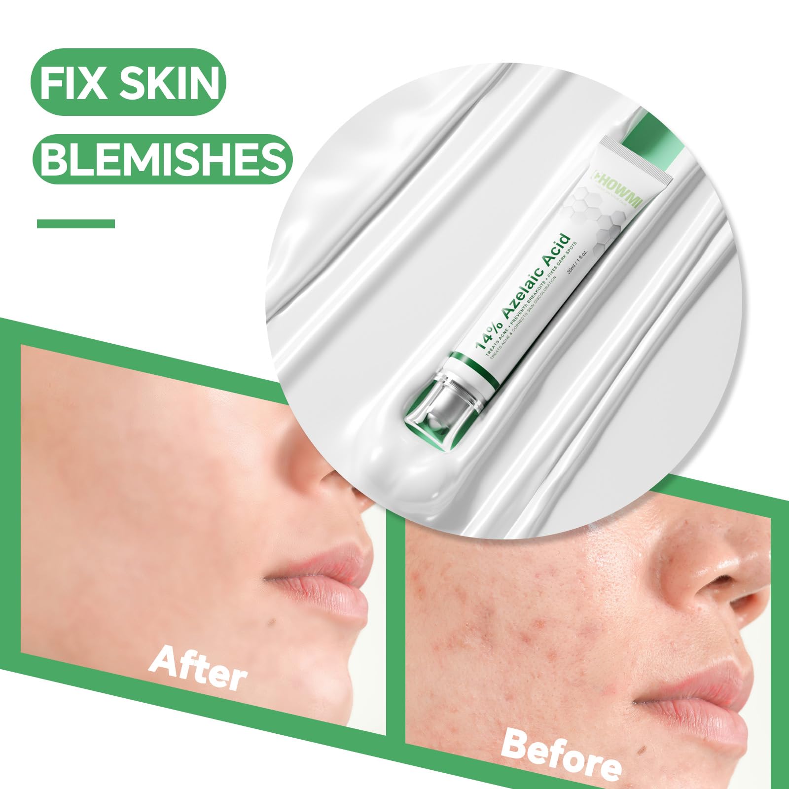 Azelaic acid 14% serum redness relief close-up demonstrates calming effect.