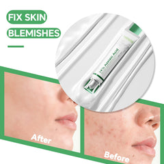 Azelaic acid 14% serum redness relief close-up demonstrates calming effect.