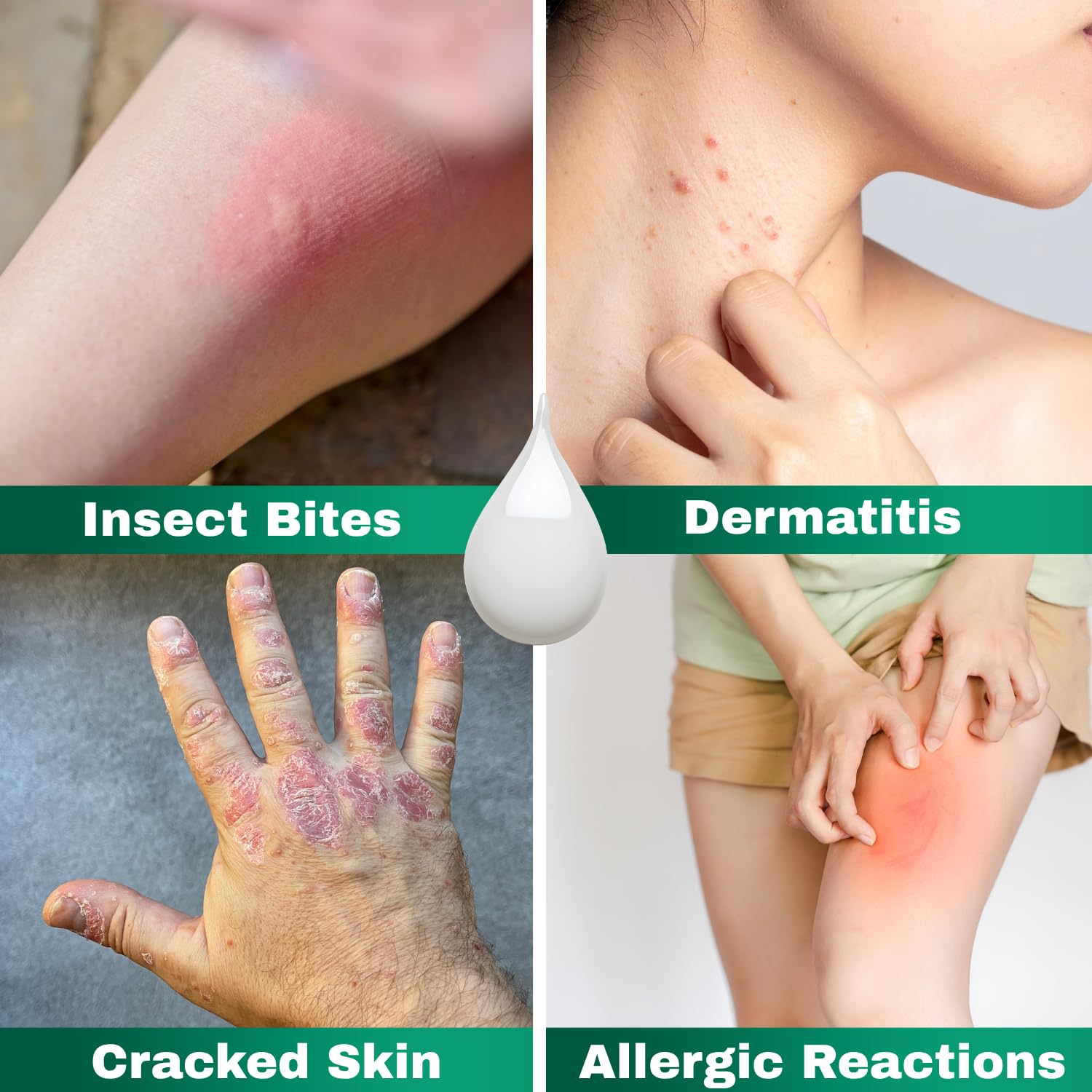 Barmicil Plus Cream being applied on skin for precise topical use