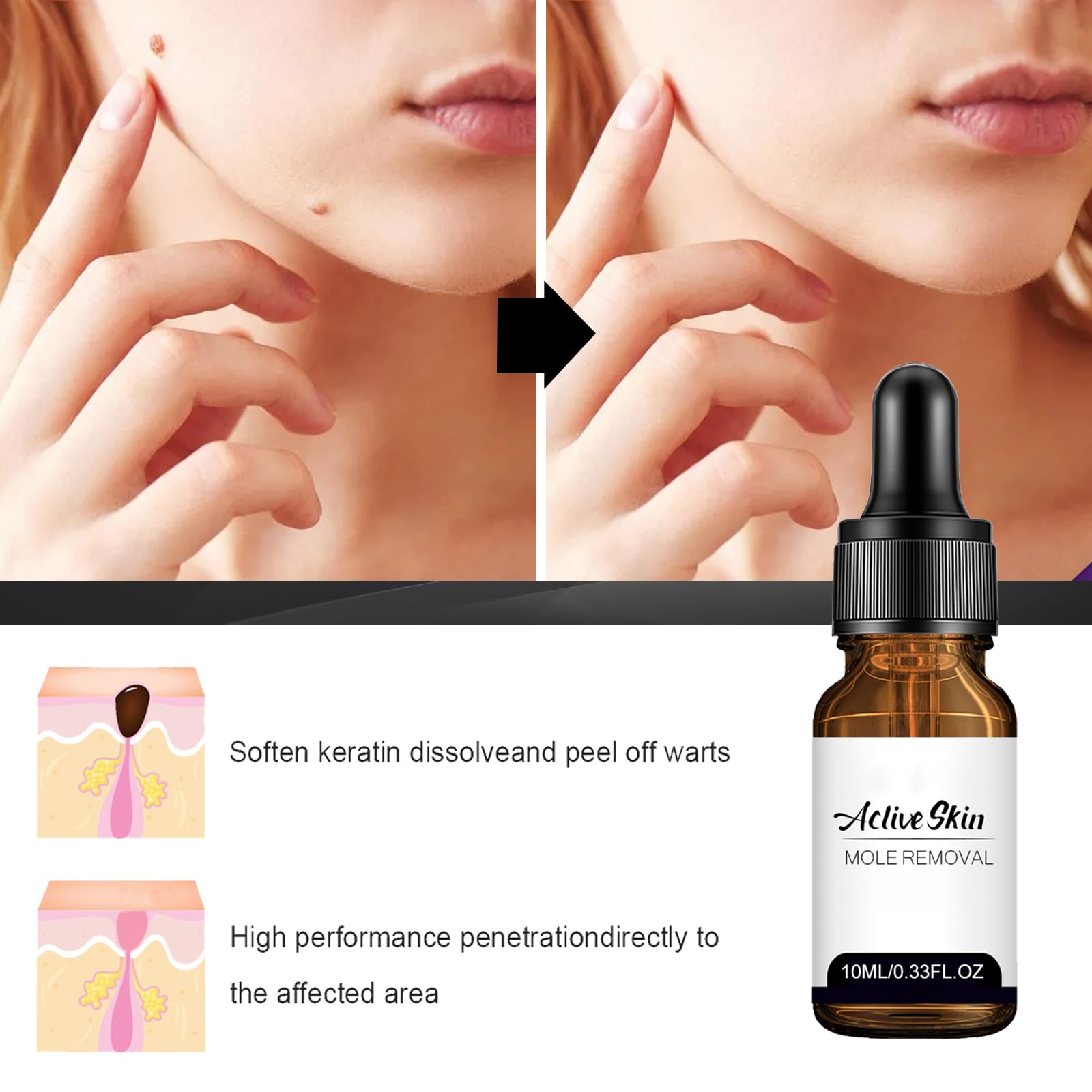 Befada plantar wart focus on affected area with fast-acting feel.