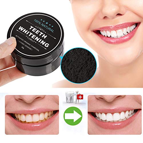Before and after teeth whitening results