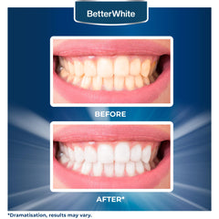 Before and after whitening results with BetterWhite
