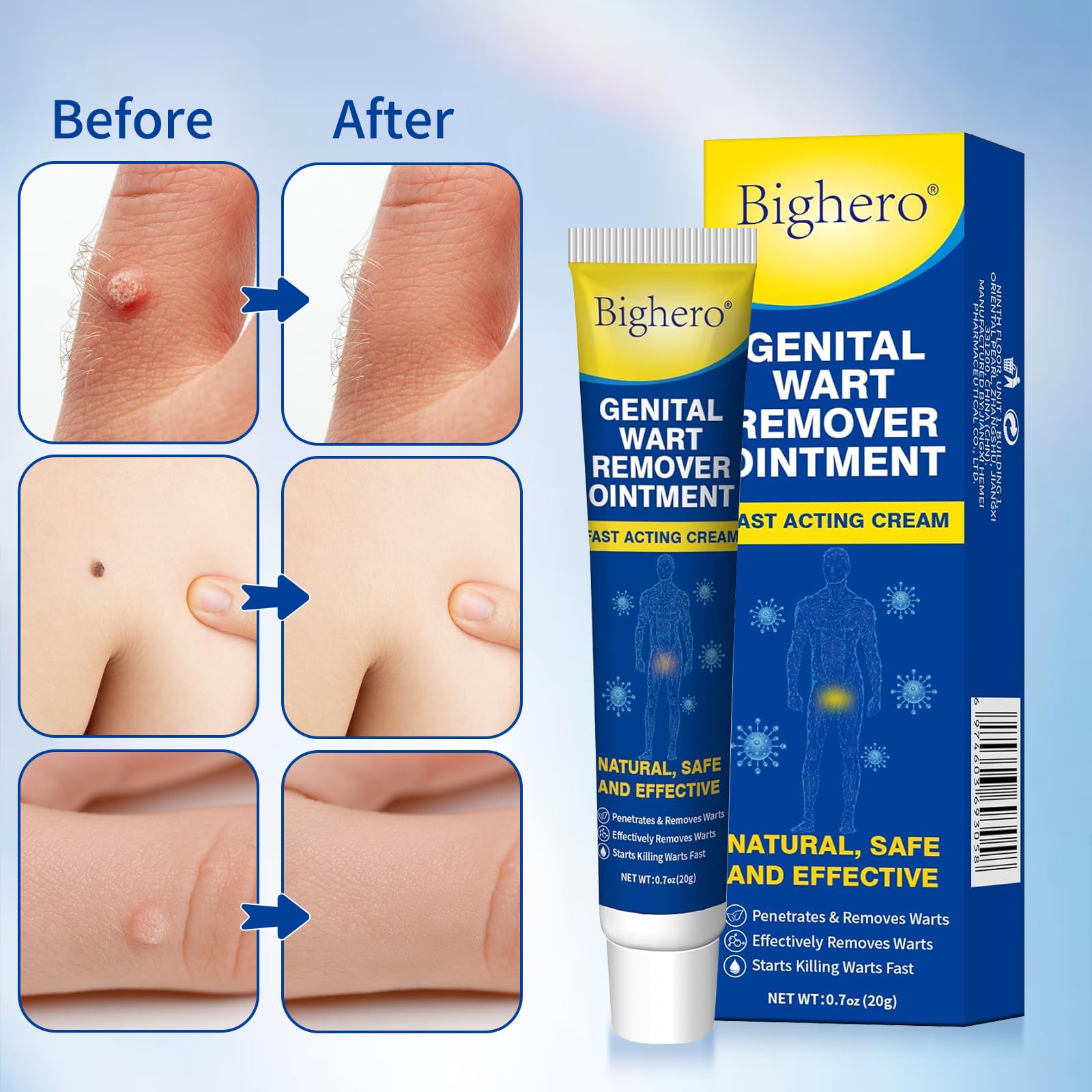 Bighero Wart Fast Acting Cream applying near a wart for gentle use