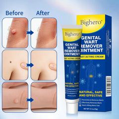 Bighero Wart Fast Acting Cream applying near a wart for gentle use