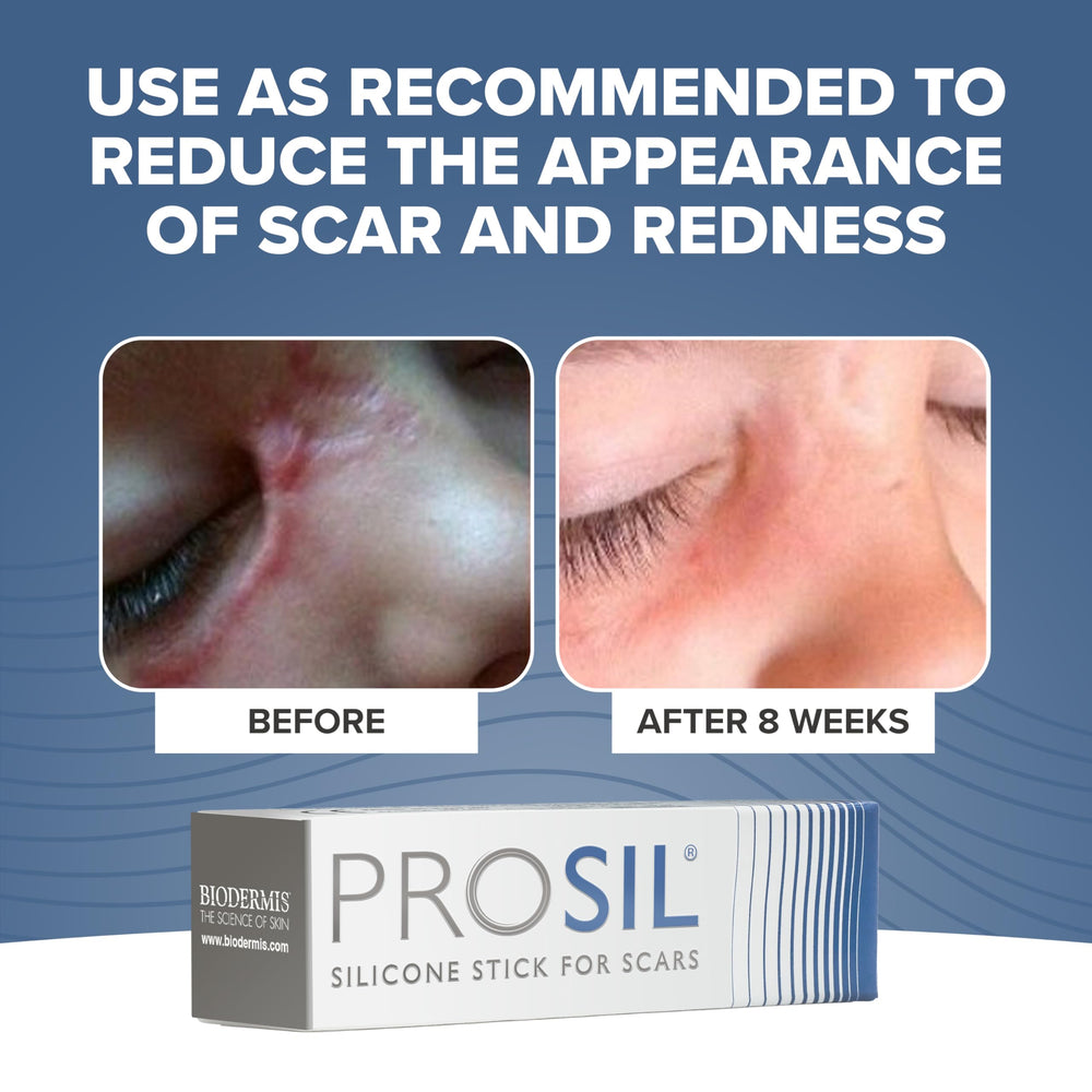 Hands holding the tube demonstrates easy, controlled application of ProSIL Scar Stick.