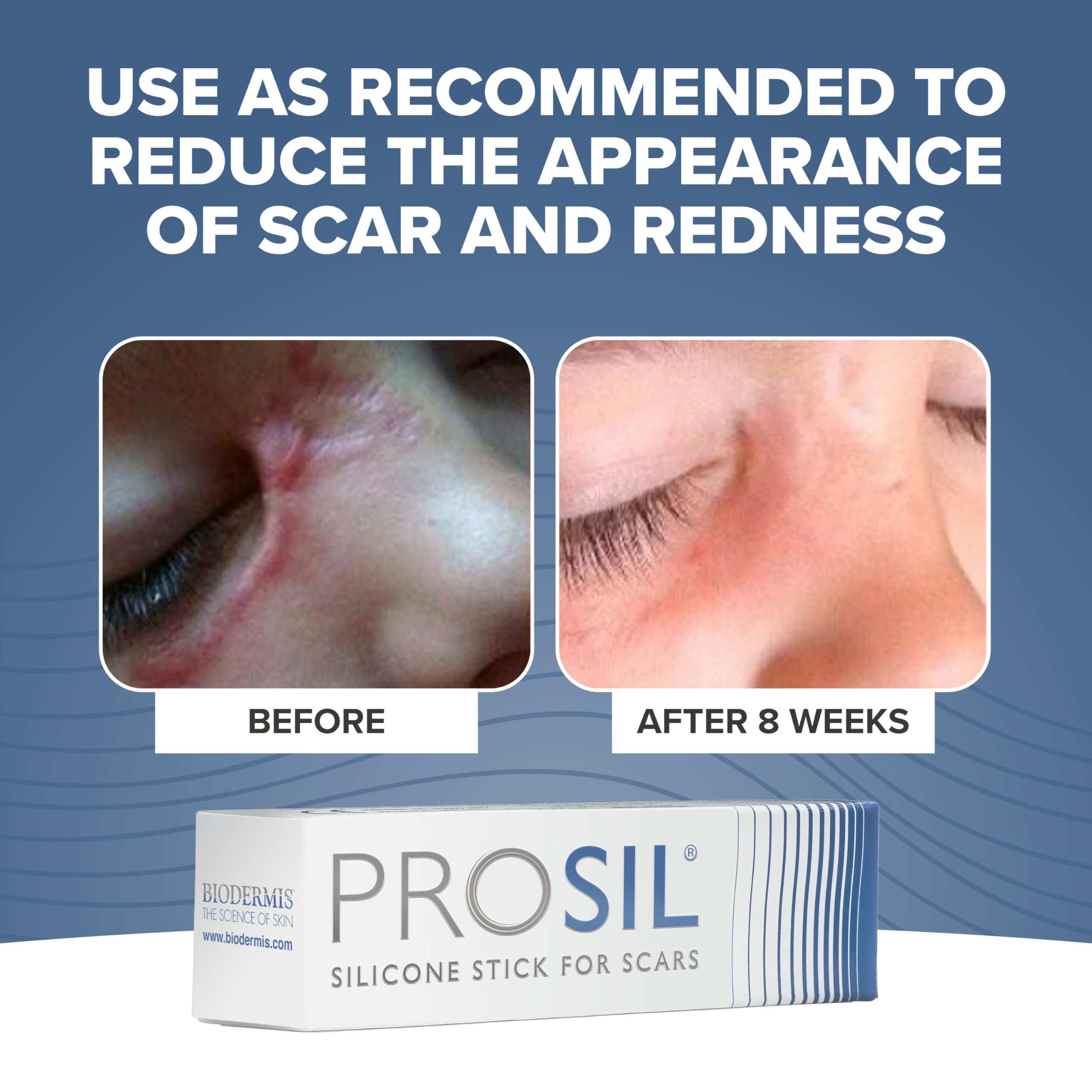 BIODERMIS PROSIL scar stick applied to skin for gentle scar care.