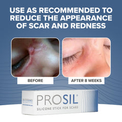 BIODERMIS PROSIL scar stick applied to skin for gentle scar care.