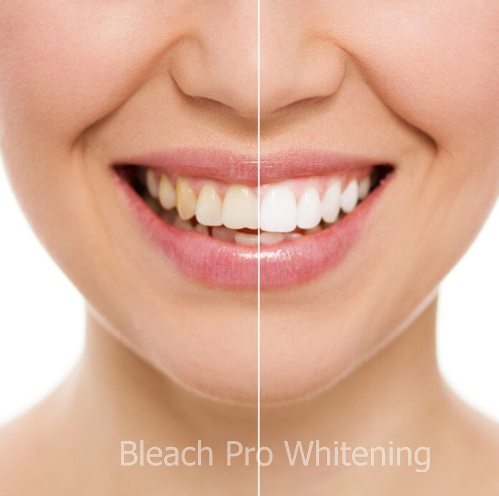 Bleaching gel syringes pack for whitening kit