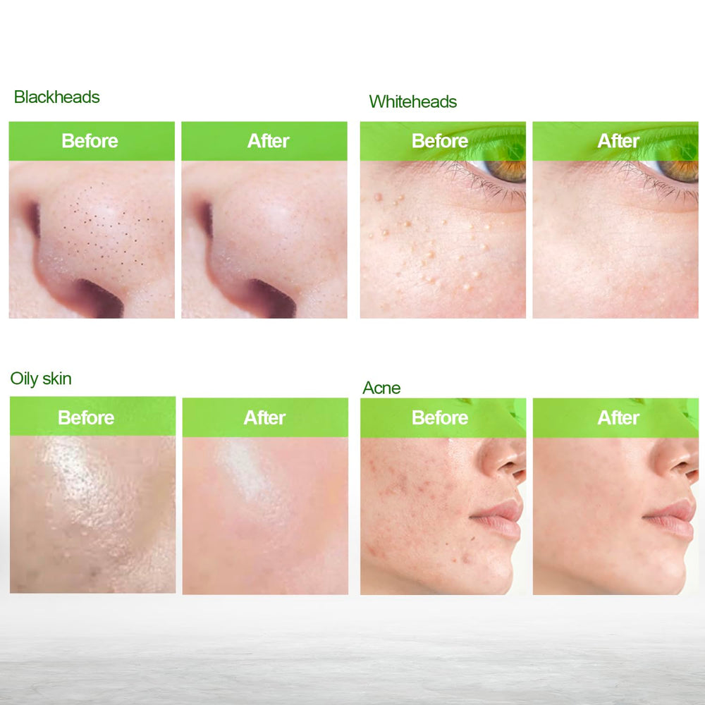 Blooskim gentle exfoliation without beads yields smoother skin.